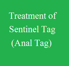 Treatment of Sentinel Tag (Anal Tag) - By Dr. V. B. Mishra - Ayirvedpuram - Allahabad